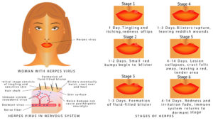 Six Critical Stages of Cold Sores